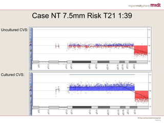 Case NT 7.5mm Risk T21 1:39
Uncultured CVS:
Cultured CVS: