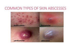 I&D By ZZ SIBISI.pptx incision and drainage | PPTX