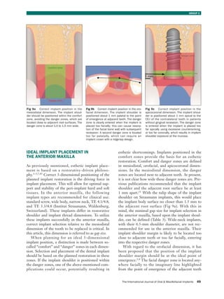 Positioning Implant Instruments Ideal implant positioning 1 | PDF
