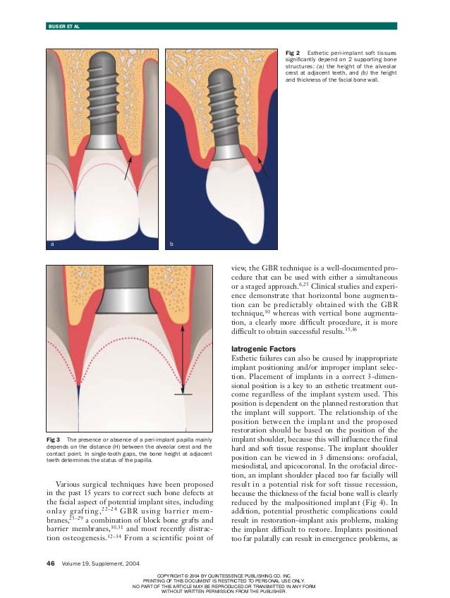 Ideal implant positioning 1