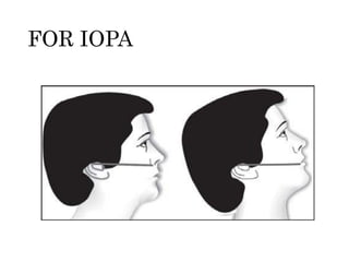 FOR IOPA
 