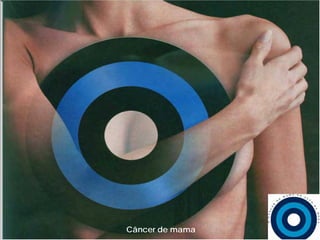Câncer de mama
 