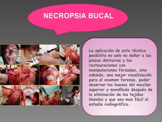 La aplicación de esta técnica posibilita no solo no dañar a las piezas dentarias y las restauraciones con manipulaciones forzadas, sino además, una mejor visualización para el examen forense, poder observar los huesos del maxilar superior y mandíbula después de la eliminación de los tejidos blandos y que sea mas fácil el estudio radiográfico. NECROPSIA BUCAL 