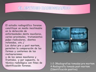 1-2-3Radiografias tomadas pre-mortem 4-Radiografía tomada post-mortem (Identificación positiva) El estudio radiográfico forense constituye un medio inestimable en la detección de enfermedades dento maxilares, caries proximales, tratamientos pulpo-radiculares, dientes retenidos, etc. ( Los datos pre y post mortem, permiten la comparación de las formas y contornos de las restauraciones  y de los senos maxilares y frontales, y por supuesto, la técnica radiológica con fines de identificación forense. 