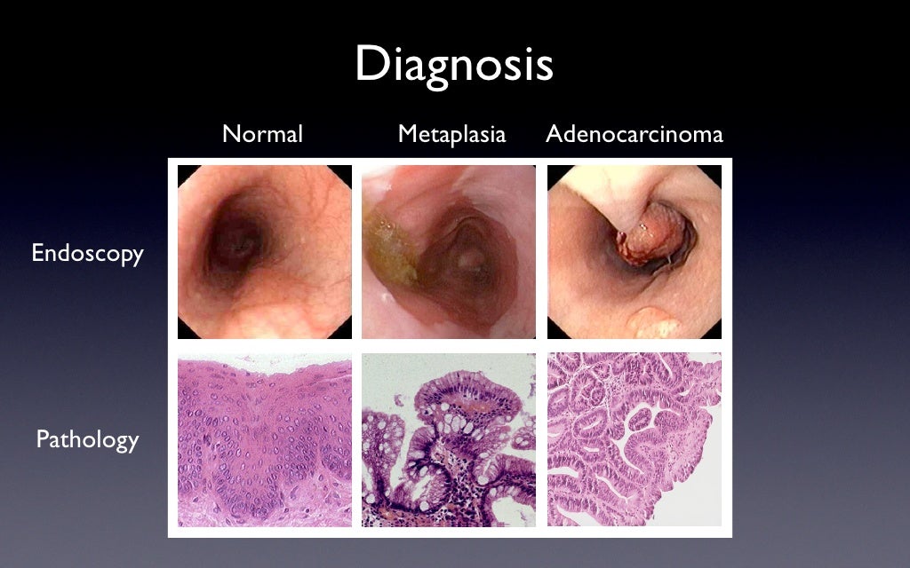 Identification of Barrett’s esophagus patients at higher risk for ade…