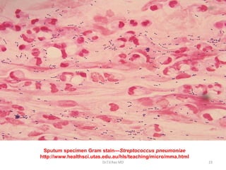 Sputum specimen Gram stain—Streptococcus pneumoniae
http://www.healthsci.utas.edu.au/hls/teaching/micro/mma.html
Dr.T.V.Rao MD 23
 