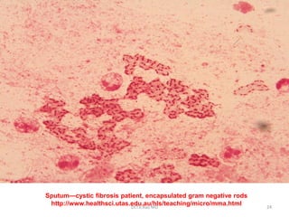Sputum—cystic fibrosis patient, encapsulated gram negative rods
http://www.healthsci.utas.edu.au/hls/teaching/micro/mma.htmlDr.T.V.Rao MD 24
 