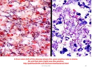 A Gram stain (left) of the abscess shows thin, gram positive rods in chains.
An acid fast stain (right) was also positive.
http://pathhsw5m54.ucsf.edu/overview/bacteria3.html
Dr.T.V.Rao MD 28
 