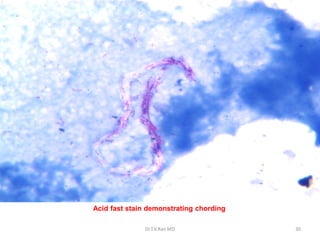 Acid fast stain demonstrating chording
Dr.T.V.Rao MD 30
 