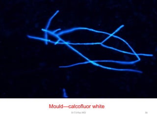 Mould—calcofluor white
Dr.T.V.Rao MD 36
 