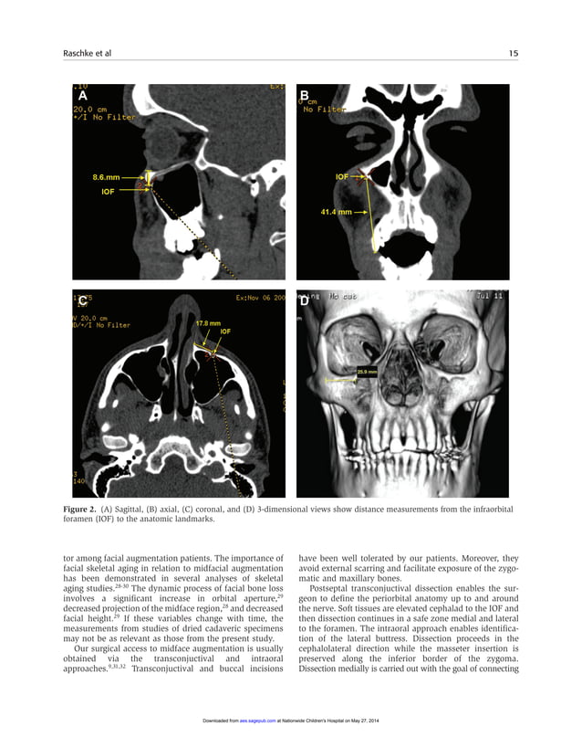 Identifying a safe zone for midface augmentation using anatomic