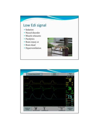Edi Signals Identifying Asynchrony and Solving the Problem - Pilbeam | PDF