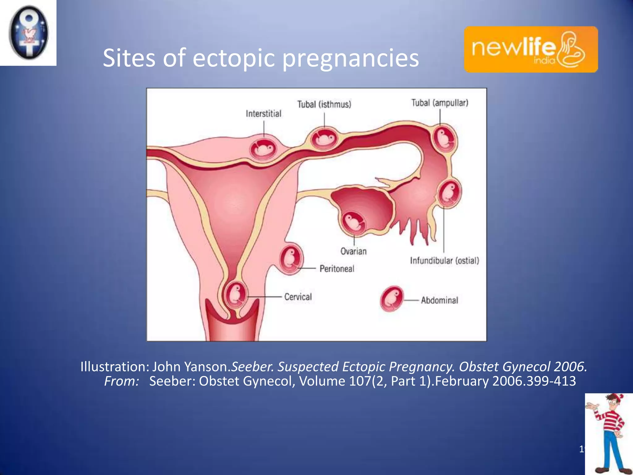 Sites of ectopic pregnancies

Illustration: John Yanson.Seeber. Suspected Ectopic Pregnancy. Obstet Gynecol 2006.
From: Seeber: Obstet Gynecol, Volume 107(2, Part 1).February 2006.399-413

19

 