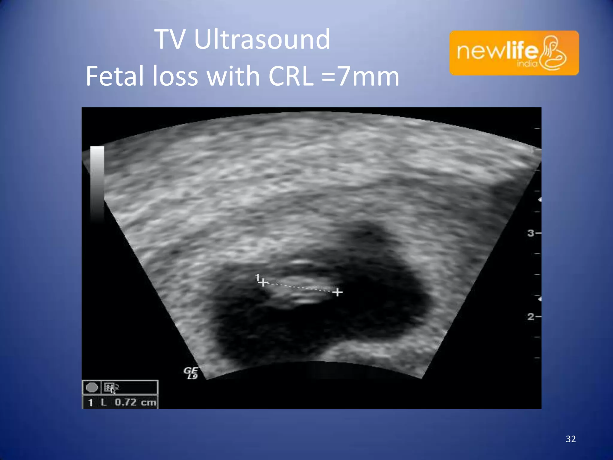 TV Ultrasound
Fetal loss with CRL =7mm

32

 