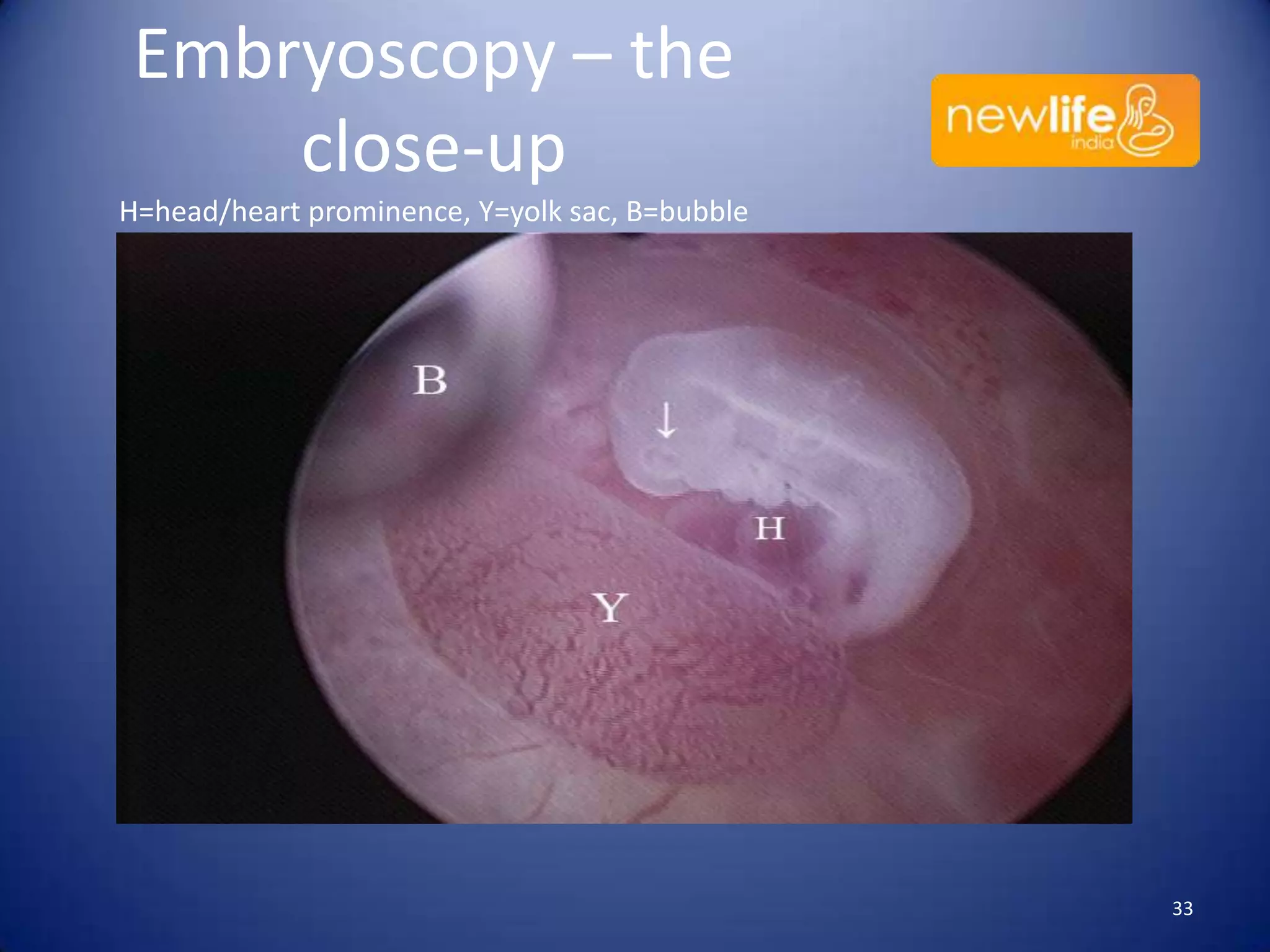 Embryoscopy – the
close-up
H=head/heart prominence, Y=yolk sac, B=bubble

33

 