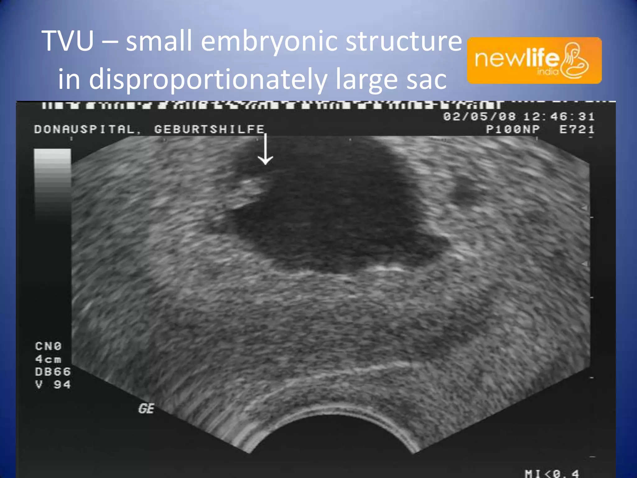 TVU – small embryonic structure
in disproportionately large sac

34

 