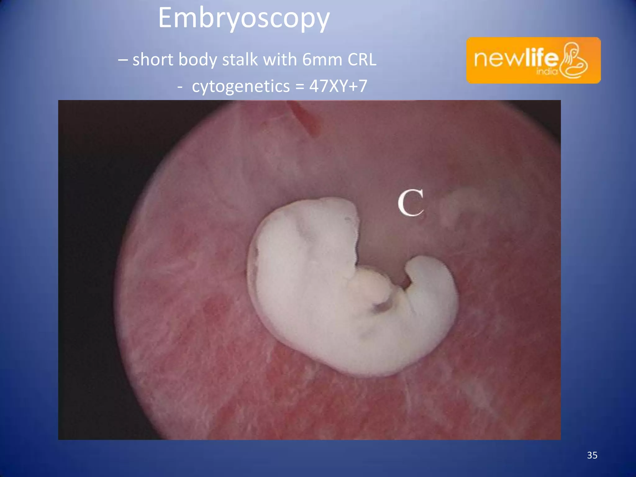 Embryoscopy
– short body stalk with 6mm CRL
- cytogenetics = 47XY+7

35

 