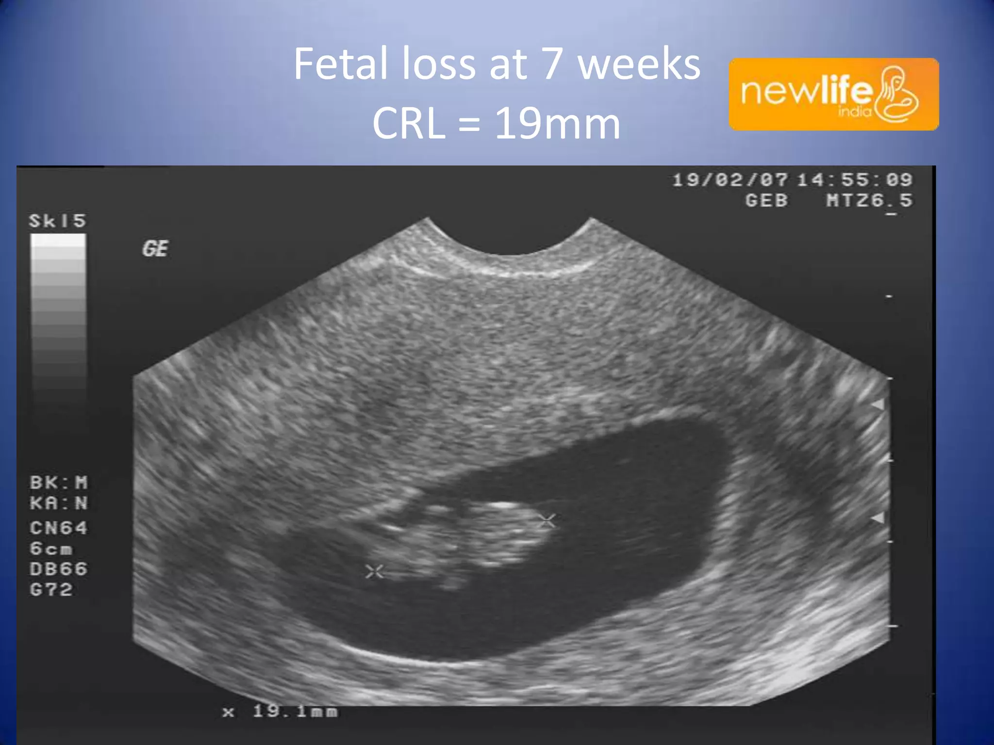 Fetal loss at 7 weeks
CRL = 19mm

36

 