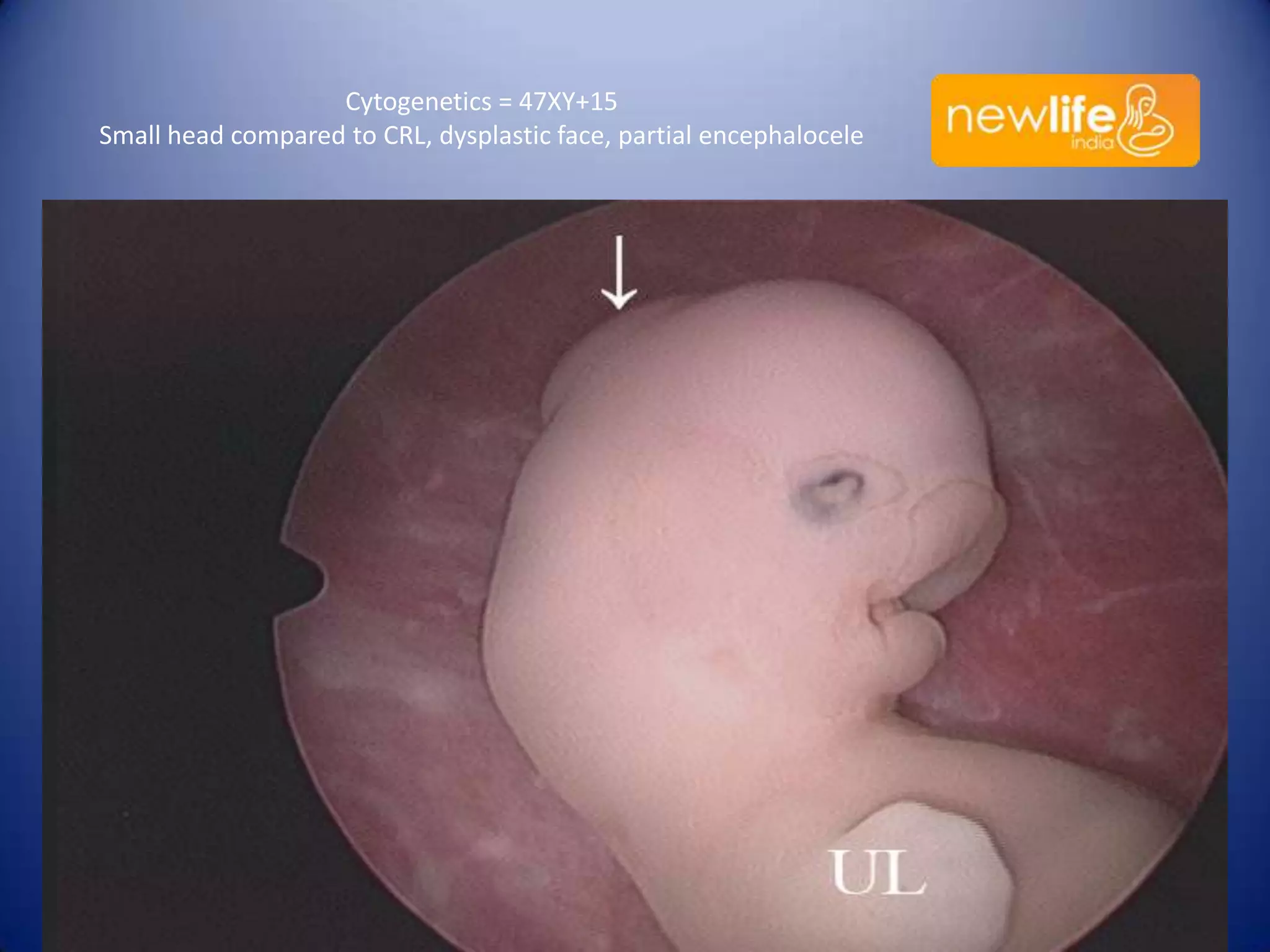 Cytogenetics = 47XY+15
Small head compared to CRL, dysplastic face, partial encephalocele

37

 