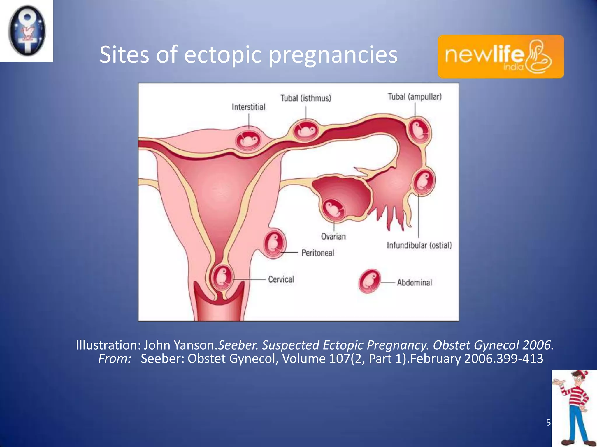 Sites of ectopic pregnancies

Illustration: John Yanson.Seeber. Suspected Ectopic Pregnancy. Obstet Gynecol 2006.
From: Seeber: Obstet Gynecol, Volume 107(2, Part 1).February 2006.399-413

55

 