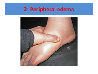 2- Peripheral edema
 