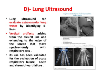 D)- Lung Ultrasound
• Lung ultrasound can
evaluate extravascular lung
water by identifying B-
lines.
• Vertical artifacts arising
from the pleural line and
extending to the edge of
the screen that move
synchronously with
respiratory acts .
• its use has been validated
for the evaluation of acute
respiratory failure acute
and chronic heart failure .
 