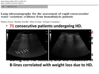 • 71 consecutive patients undergoing HD.
• Ultrasound, bioimpedance and clinical
measurements were performed immediately
before and after (within 15 min) dialysis
sessions.
• A significant reduction in B-lines numbers
during the HD session, and the reduction in
B-lines correlated with weight loss due to HD.
 
