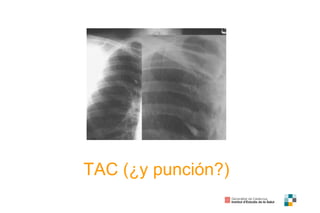 TAC (¿y punción?) 