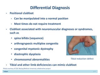 Idiopathic-Talipes-Equinovarus-Congenital-Clubfoot.pptx