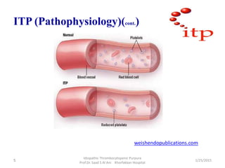ITP (Pathophysiology)(cont.)
weishendopublications.com
1/25/2015
Idiopathic Thrombocytopenic Purpura
Prof.Dr. Saad S Al An...