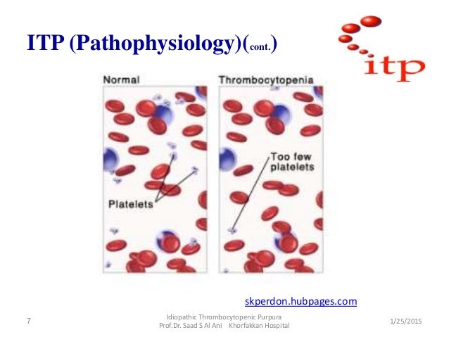 immune thrombocytopenic purpura
