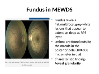 IDIOPATHIC CHORIORETINOPATHIES. PRESENTATION | PPTX