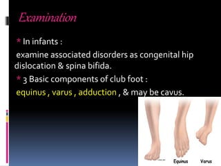 Idiopathic club foot | PPTX