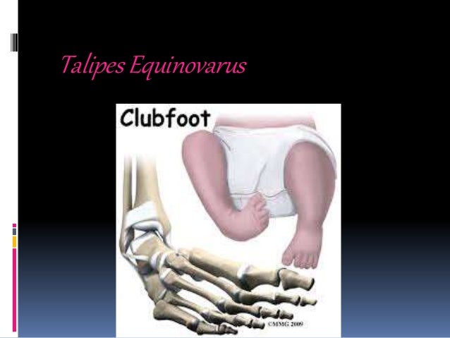 Idiopathic Club Foot Idiopathic Club Foot