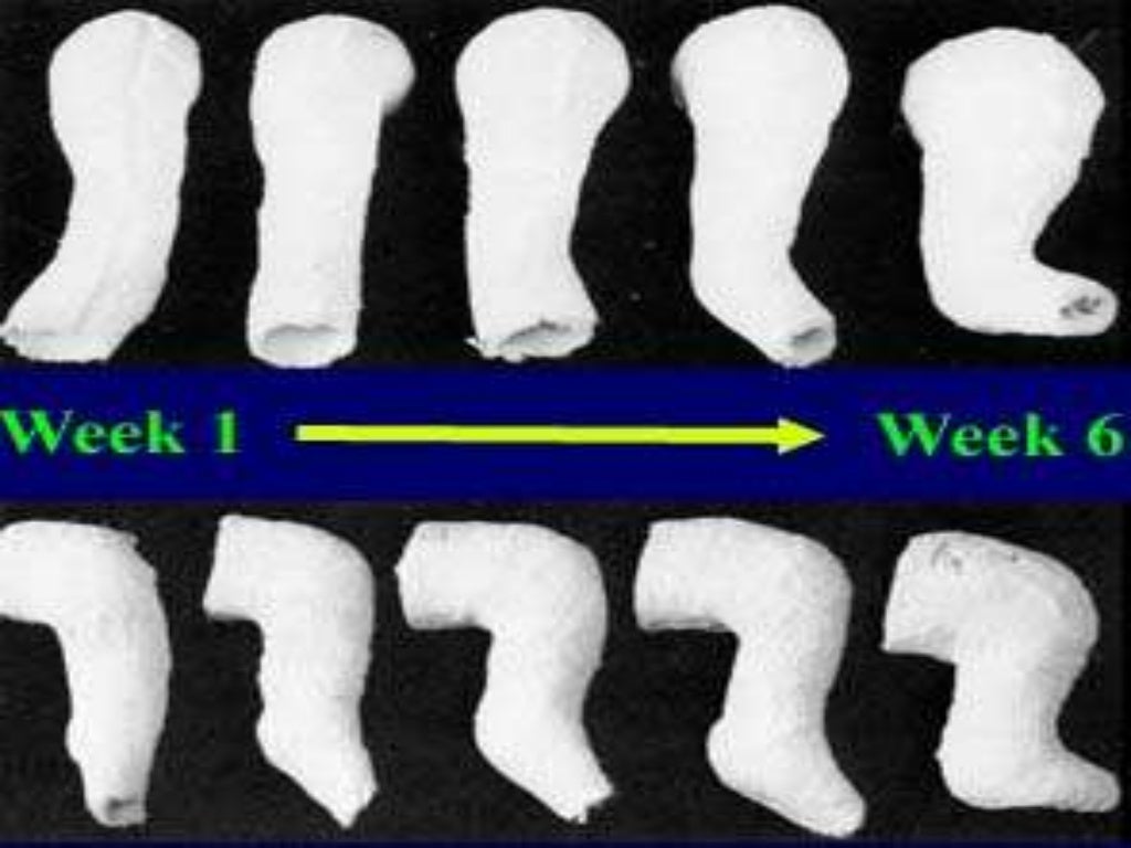 Idiopathic club foot