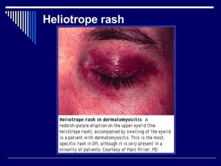 Haliotrop Rash Idiopathic Inflammator Myopathie Dr.Mark Boulos June5 07fin | PPT