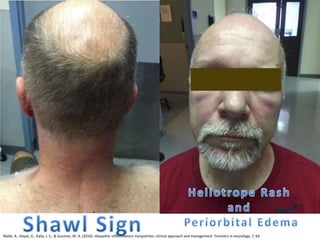 Malik, A., Hayat, G., Kalia, J. S., & Guzman, M. A. (2016). Idiopathic inflammatory myopathies: clinical approach and management. Frontiers in neurology, 7, 64.
 