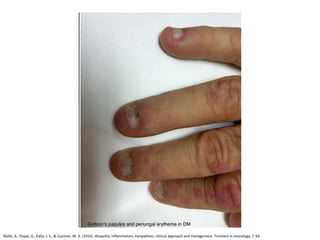 Malik, A., Hayat, G., Kalia, J. S., & Guzman, M. A. (2016). Idiopathic inflammatory myopathies: clinical approach and management. Frontiers in neurology, 7, 64.
 