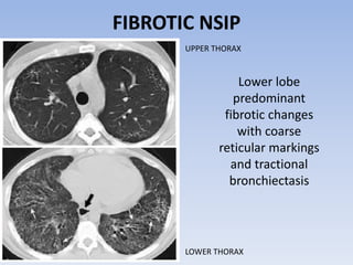 Idiopathic interstitial pneumonias | PPT
