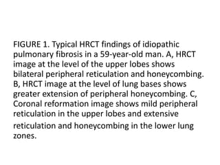 Typical Reticulation Line Idiopathic Interstitial Pneumonias.pptx