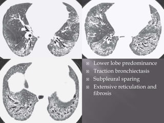  Lower lobe predominance
 Traction bronchiectasis
 Subpleural sparing
 Extensive reticulation and
fibrosis
 