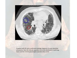 Ipf Radiopaedia Idiopathic pulmonary fibrosis copy | PPTX
