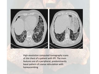 Ipf Radiopaedia Idiopathic pulmonary fibrosis copy | PPTX