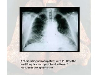 Ipf Radiographic Idiopathic pulmonary fibrosis copy | PPTX
