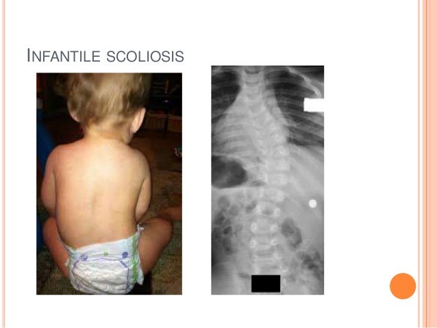 Резултат с изображение за infantile scoliosis