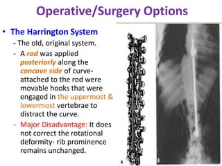 Cd Harrington Rods Idiopathic scoliosis | PPTX