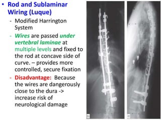 Cd Harrington Rods Idiopathic scoliosis | PPTX