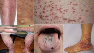 Idiopathic thrombocytopenic purpura | Dr Qaisar Ahmed