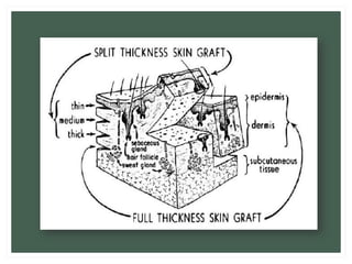 Skin graft and skin flap | PDF