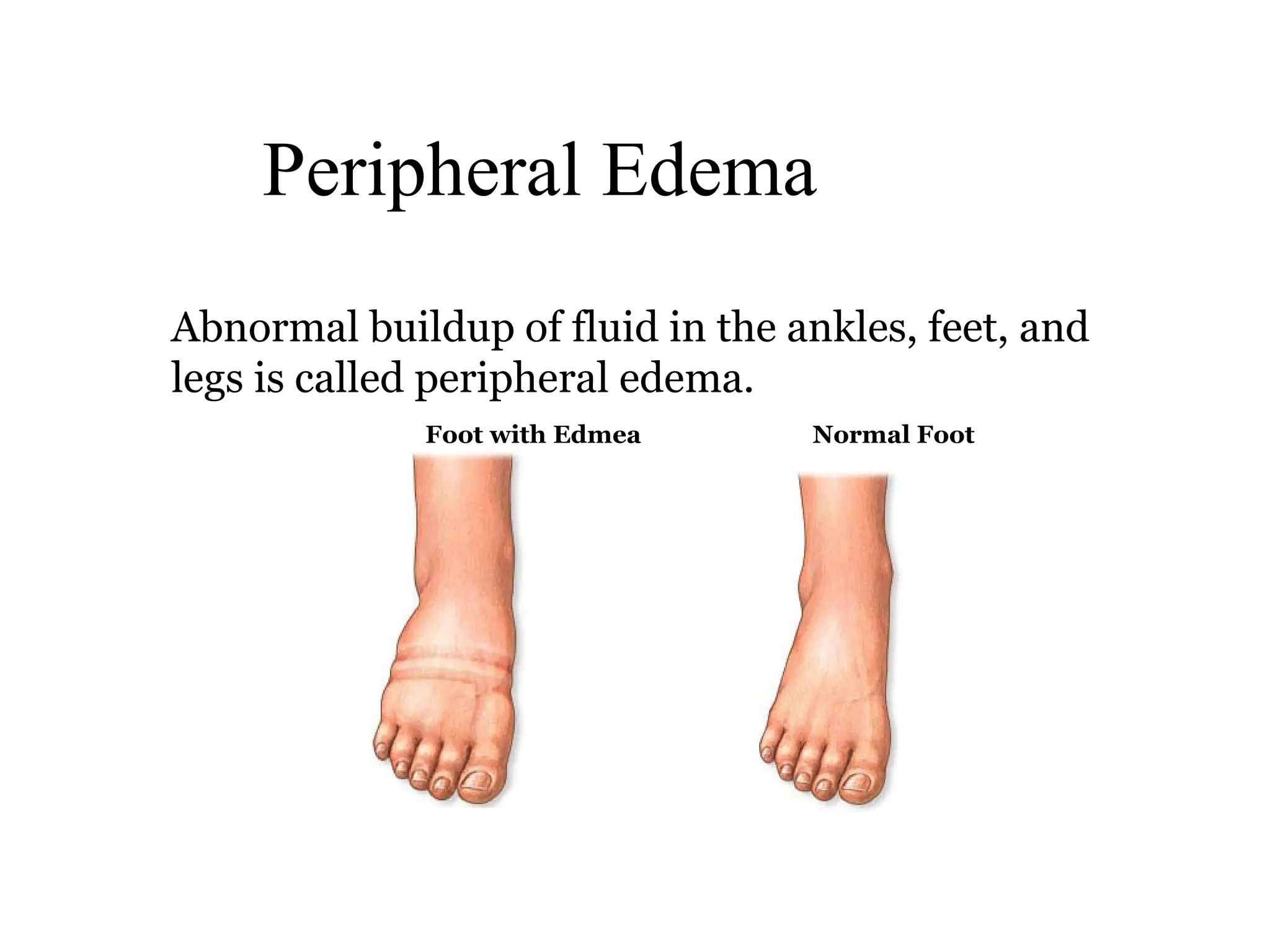 Peripheral Edema
Abnormal buildup of fluid in the ankles, feet, and
legs is called peripheral edema.
             Foot with Edmea      Normal Foot
 